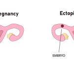 intrauterine pregnancy